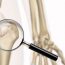 Osteoporóza: Příznaky, Prevence a Léčba